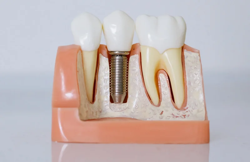Model showing a dental implant between natural teeth.