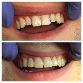 Before and after dental restoration showing a dramatic smile improvement.