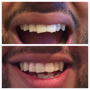 Close-up of a mouth before and after dental treatment.