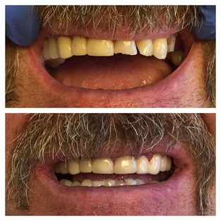 Before and after dental restoration showing improved teeth.
