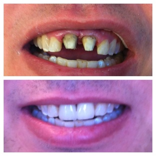 Before and after dental restoration showing dramatic smile improvement.