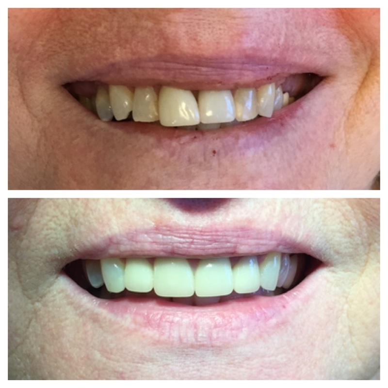 Before and after teeth whitening showing a brighter smile.