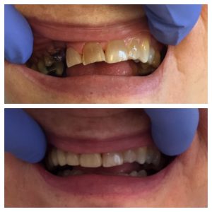 Before and after dental restoration showing significant improvement in teeth appearance.