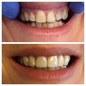Before and after dental restoration showing improved teeth alignment and color.
