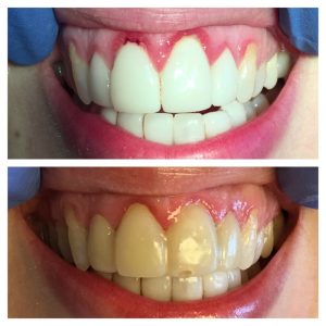 Comparison of teeth before and after whitening treatment.