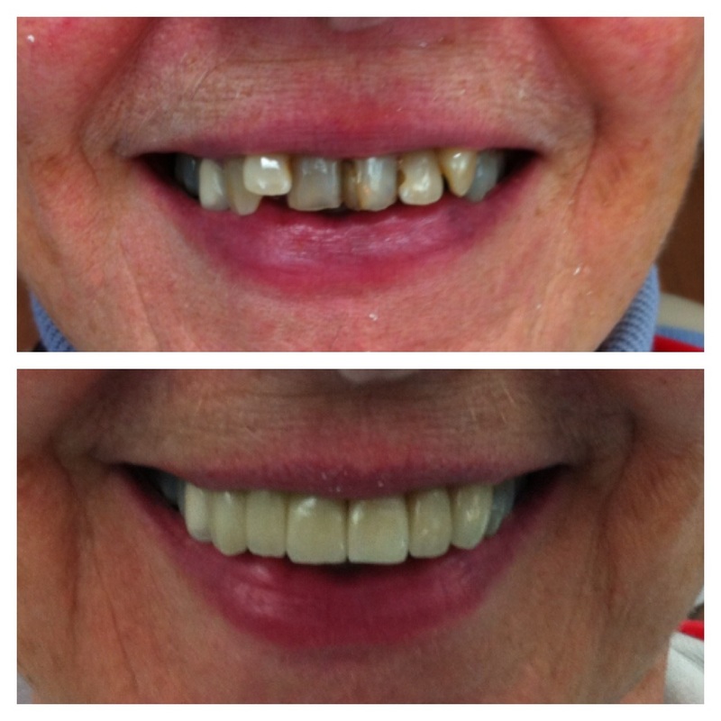 Before and after dental restoration showing improved teeth appearance.