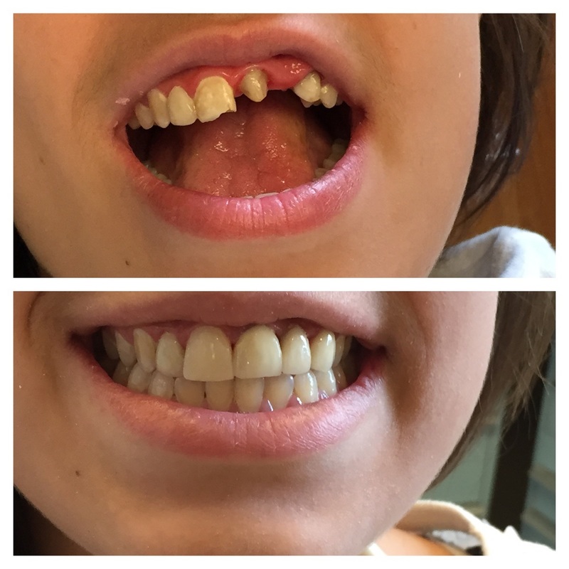 Before and after photos showing dental transformation from crooked to straight teeth.