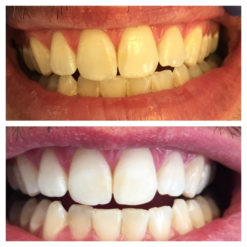 Before and after teeth whitening showing significant improvement.
