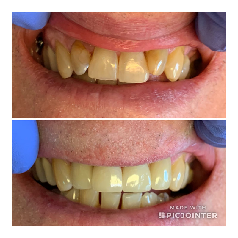Before and after dental treatment showing improved teeth alignment and color.