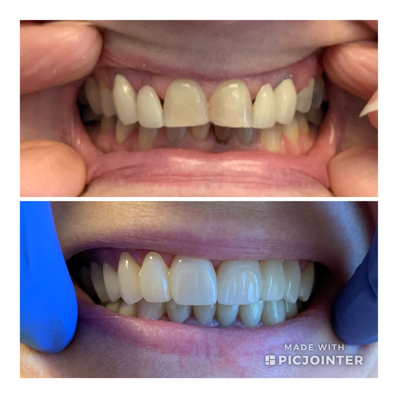 Before and after teeth whitening showing significant improvement.