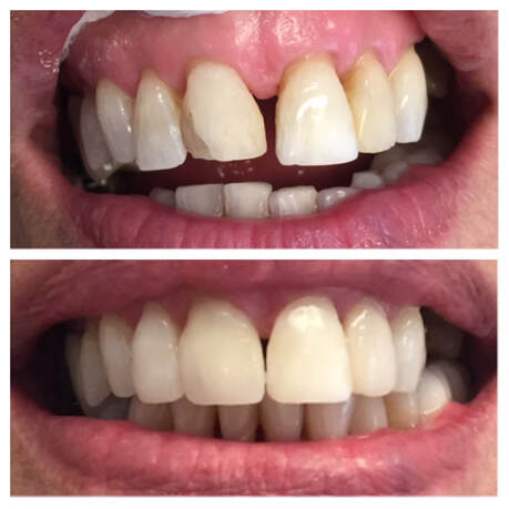Before and after dental restoration showing improved teeth appearance.