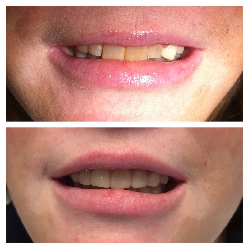 Before and after dental restoration showing improved teeth appearance.