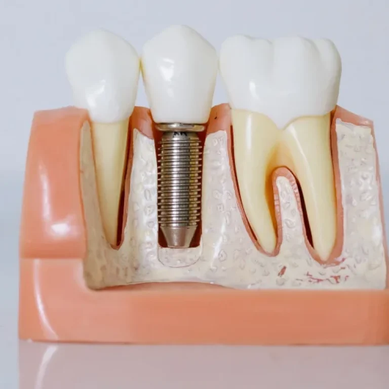 Model showing a dental implant between natural teeth.
